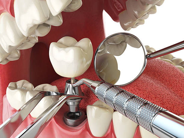Best Emergency Dentist for Lost Fillings or Crowns in India Hook, SC